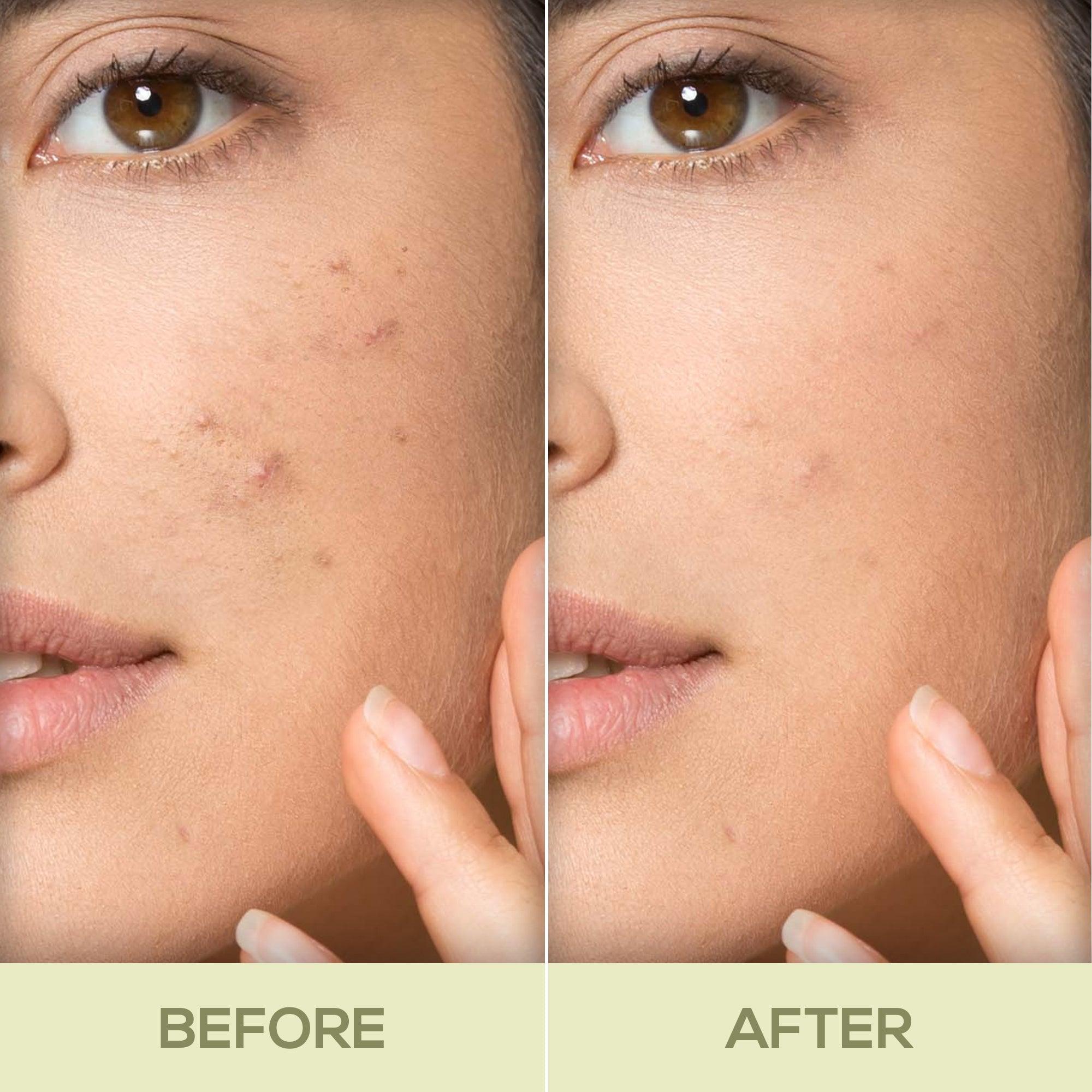 RENEE Acne Filter 15gm - Renee Cosmetics