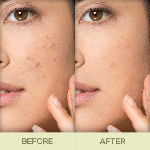 RENEE Acne Filter 15gm - Renee Cosmetics